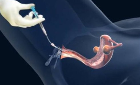 这个价格你敢相信，在国外做试管助孕费用没你想像的贵